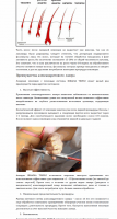 Лазерная эпиляция на аппарате IRRADIA TRIPLE